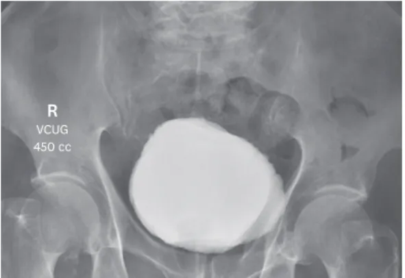 Fig. 3. The VCUG test shows the recovery to normal bladder volume and the diverticulum disappear after surgery