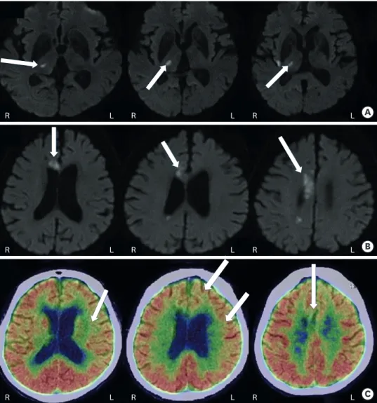 Fig. 1. Structural and functional brain imaging of the brain. (A) The brain MRI after first infarction shows increased  signal intensity (arrows) at right thalamus