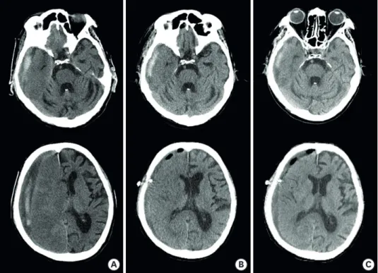 Fig. 1. Brain computed tomography scans over time. (A) Day of onset. (B) Postoperative evaluation on day 4 after  onset