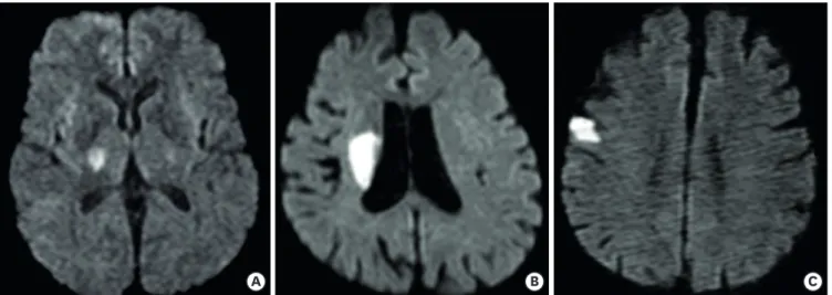 Fig. 1. MRI diffusion weighted image of cerebral infarction areas in MCA territory. MRI diffusion weighted images of enrolled patients had acute ischemic stroke in  (A) basal ganglia, (B) corona radiata, and (C) motor cortex, which can influence motor func