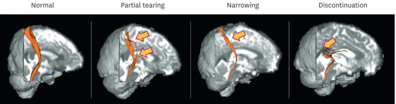 Fig. 1. Configurational analysis of the STT in patients with mTBI (reprinted from reference 66)