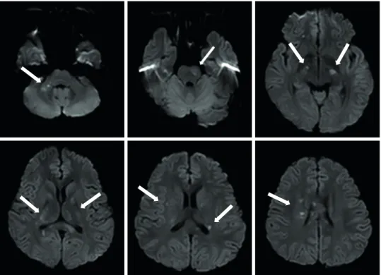 Fig. 1. Brain magnetic resonance imaging scan showing a multifocal diffusion restriction with a fluid-attenuated  inversion-recovery signal change.