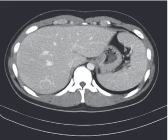 Fig. 3. Abdominal computed tomography scan showing splenomegaly, which is a characteristic finding of Still's  disease.