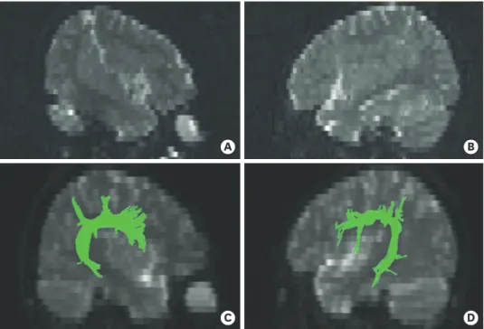 Fig. 3. The results of fiber tracking in the patient (A, left; B, right) and control (C, left; D, right)
