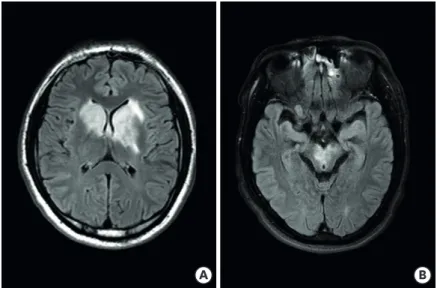 Fig. 1. The axial sections of fluid-attenuated inversion recovery imaging of the patient