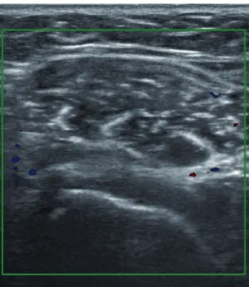 Fig. 1. Follow-up sonographic finding right after botulinum toxin injection.