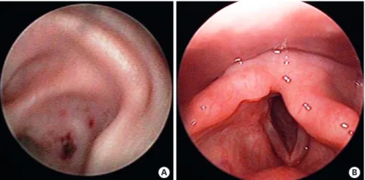 Fig. 1. (A) Vesicular eruptions on the cymba concha (left) on rigid telescopic examination