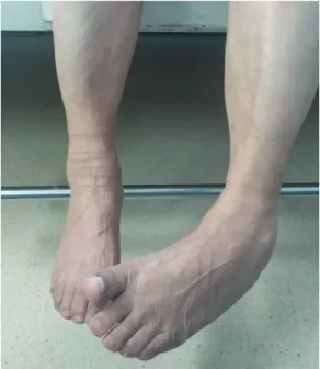 Fig. 1. Inversion of left ankle in case 1 patient.