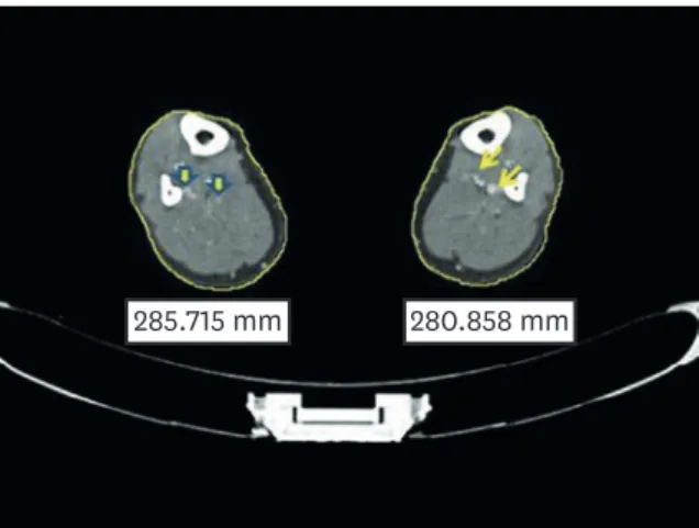 Fig. 1. Measurement of the circumference of bilateral lower limbs. Thick arrows show DVT in right sural vein and  thin arrows indicate normal left sural vein