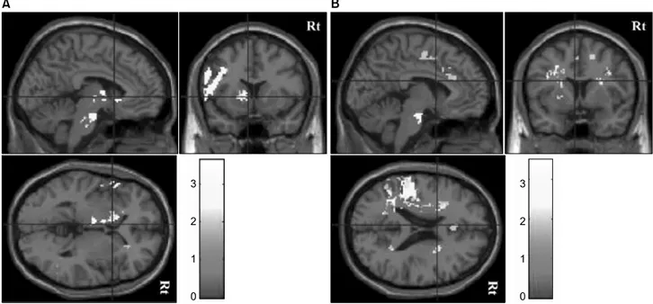 Fig. 2. Overlay lesion plots of the poststroke patients as concerned with affective depression (A) and apathetic depression (B)