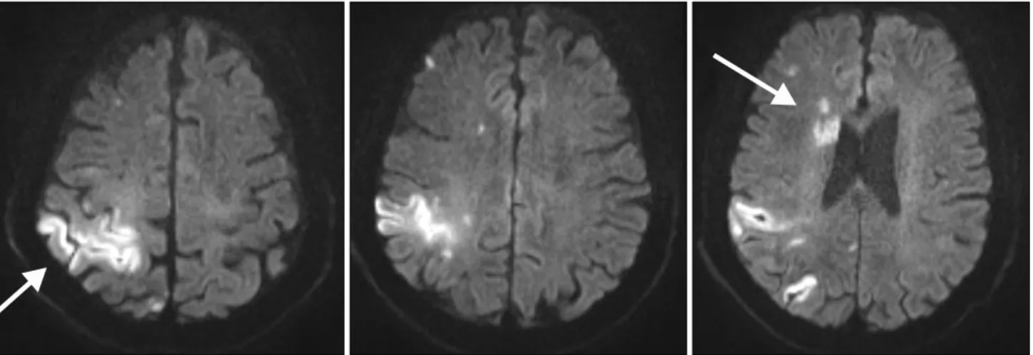 Fig.  1.  Brain  diffusion  MRI  at  the  onset  of  cerebral  infarction  showed  high  signal  intensity  in  diffusion  weighted  image  in  right  frontoparietal,  right  anterior  corona  radiata,  right  caudate  head,  and  right  upper  basal  gang