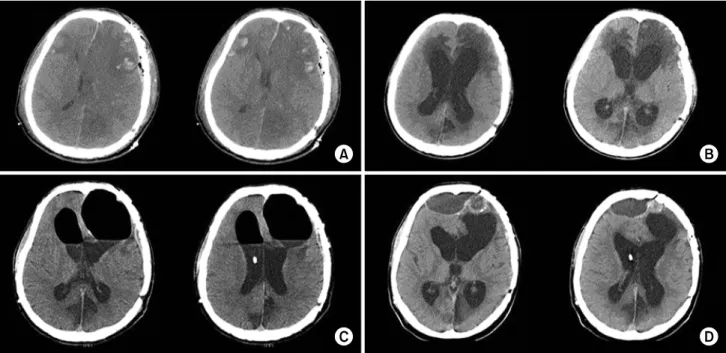 Fig.  1.  Serial  changes  of  brain  CT  (A)  Initial  brain  CT  after  traumatic  accident  showed  multiple  hamorrhage