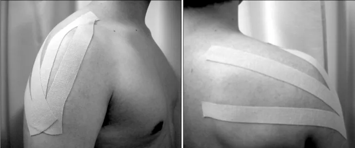 Fig.  1.  The  shoulder  taping  therapy  on  shoulder.  The  tapes  were  attached  from  humerus  insertion  of  deltoid  muscle  respectively  following  anterior  and  middle  deltoid  line  to  extension  line  of  clavicle  midline  and  horizontally