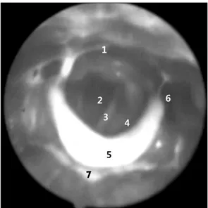 Fig.  2.  View  with  fiberoptic  endoscopic  evaluation  of  swallowing  (FEES).  (1)  Route  to  esophagus,  (2)  trachea,  (3)  vocal  cord,  (4)  aryepiglottic  folds,  (5)  epiglottis,  (6)  pyriform  sinus,  (7)  fluid  with  dye  in  vallecula.