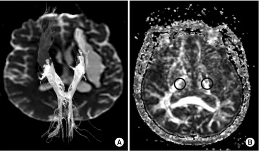 Fig.  2.  Diffuse  Tensor  Image  Trac- Trac-tography  (DTT)  showing  fiber  tract  from  both  motor  cortex  descended  through  the  corticospinal  tract  (A)