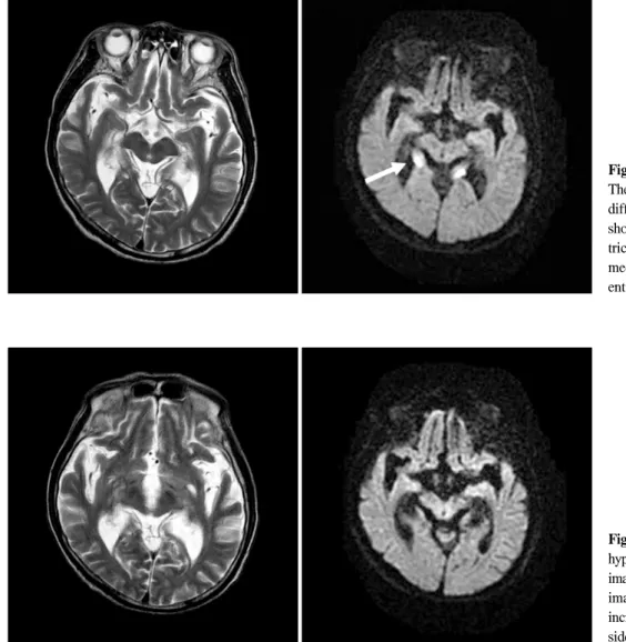 Fig.  2.  Brain  MRI  at  5  months  after  hypoglycemic  attack.  The  T2-weighted  image  (T2WI)  and  diffusion  weighted  image  (DWI)  showed  atrophy  with  increased  T2  signal  intensity  in  both  side  hippocampus