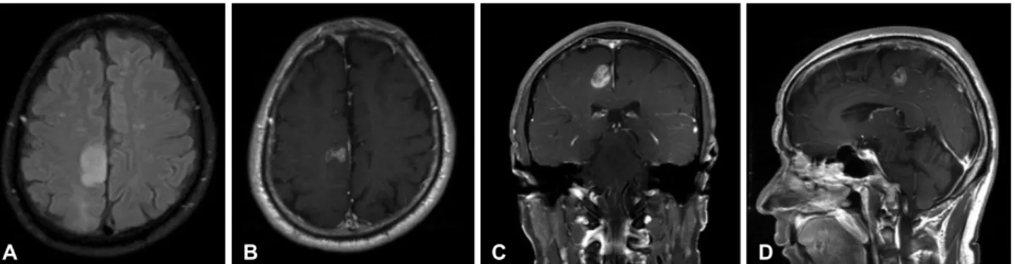 Fig. 1. The second MR image at the time of occurrence of progressive hemiparesis on the left side showing increased size of the previous  area with high signal intensity in fluid attenuated inversion recovery image (A), and nodular rim enhancement at size 