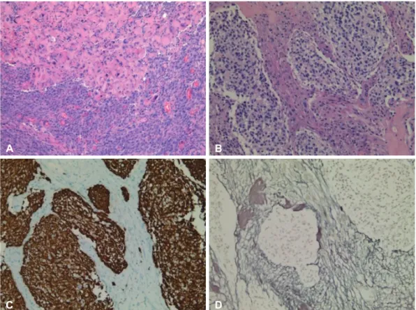 Fig. 3. Histopathological features showing two biphasic patterns in tumor of epithelioid glial component (upper lane) and cellular spindle  mesenchymal component (bottom lane); (H&amp;E staining, ×20) (A)