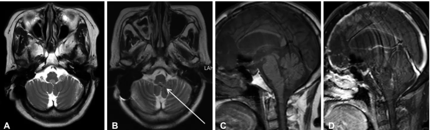 Fig. 1. Initial MRI at the time of diagnosis and retrospectively traced mass at 6 years ago MRI