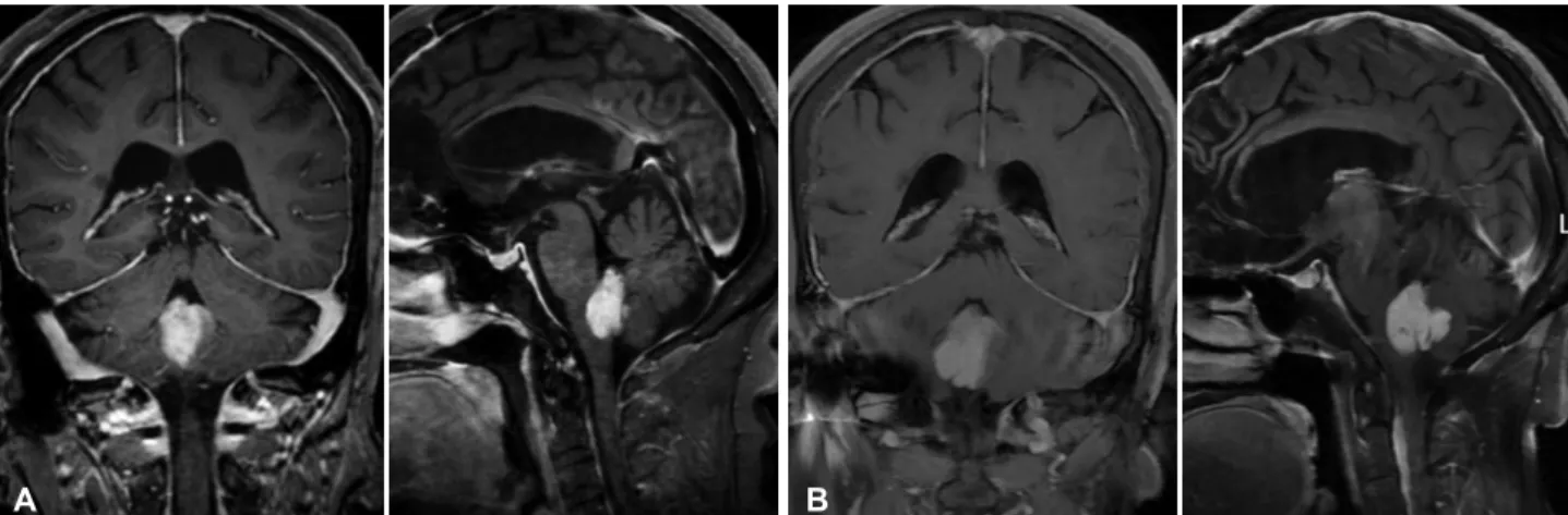 Fig. 3. Comparison of mass size on T1 gadolinium enhanced MR images between (A) the last year of patient being asymptomatic and (B)  the 7th year of patient developing intolerable nausea and vomiting at the age of 74 years-old.