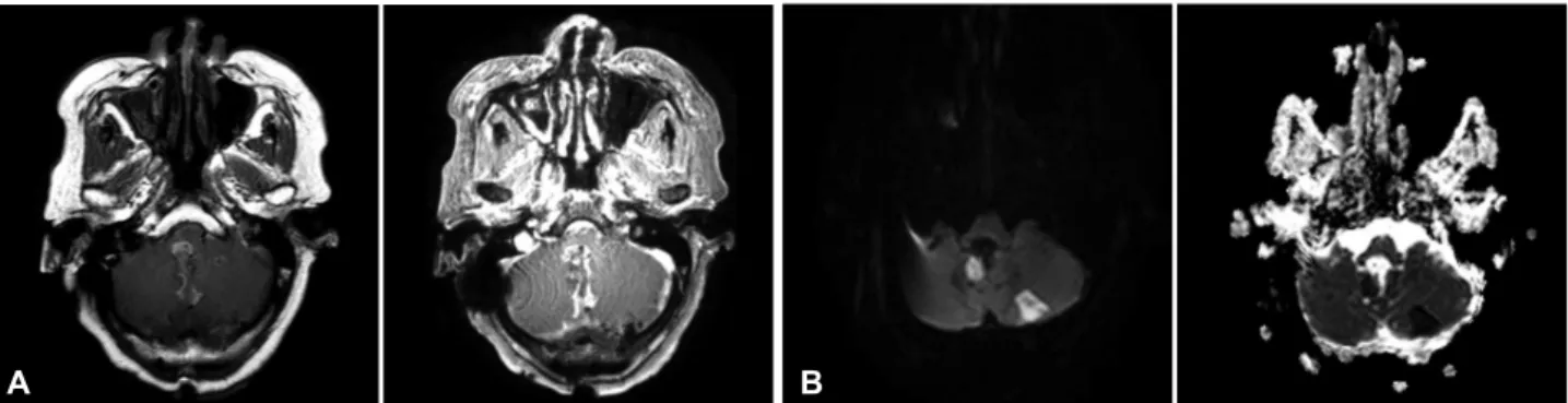Fig. 6. Postoperative MRI revealed total excision of enhancing mass with linear enhancement of surgical tract (A)