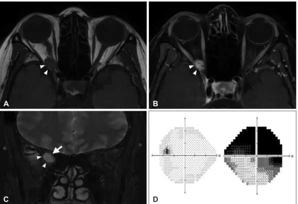 Fig. 1. Preoperative MRI and visual field test. A: T1-weighted image shows isointense 13 mm-sized intraconal tumor (white arrow heads) at  right orbital apex