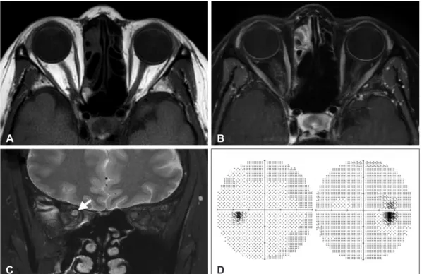 Fig. 2. Histopathological examination. A: In low power view (H-E ×12), a well demarcated soft tissue mass with many vascular channels  are seen
