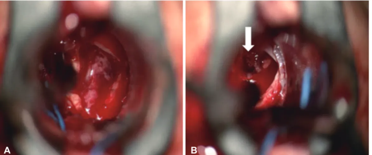 Fig.	3. Intra-operative picture showing necrotic material flowing out after dura incision (A) and a mass with blood clot (white arrow) (B).