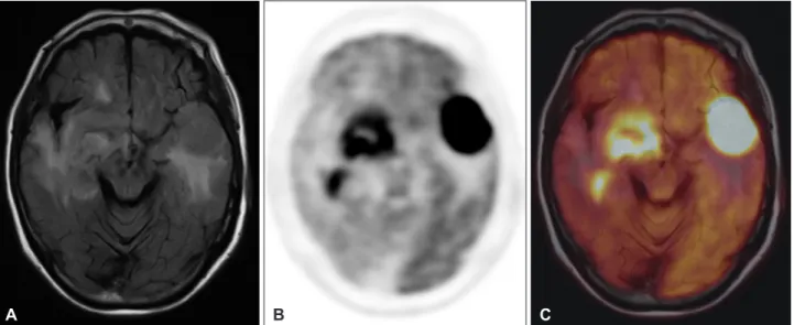 Fig. 1. FDG PET/MR for CNS lymphoma. 79-year-old woman diagnosed as CNS lymphoma. T2 fluid attenuated inversion recovery MRI  shows multiple lesions with high signal in both hemisphere (A)
