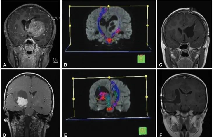 Fig. 3. Demonstration of planning of surgical approach via preoperative DTI. Coronal MRI (A) and DTI (B) show left thalamic tumor with an- an-teromedially displaced thalamus and laterally deviated PLIC