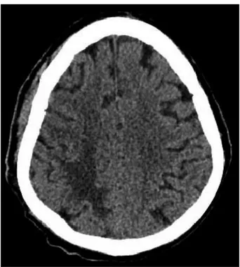 Fig.	3. Non-enhanced brain computed tomography reveals re- re-gression of the scalp lesion and intracranial lesion after 2 weeks  of chemotherapy.