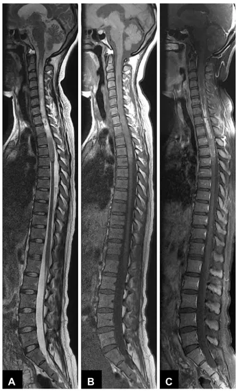 Fig. 1. Initial spinal magnetic resonance image (MRI) scan. A: T2- T2-weighted MRI shows an abnormal spinal cord lesion from C2  lev-el to D5