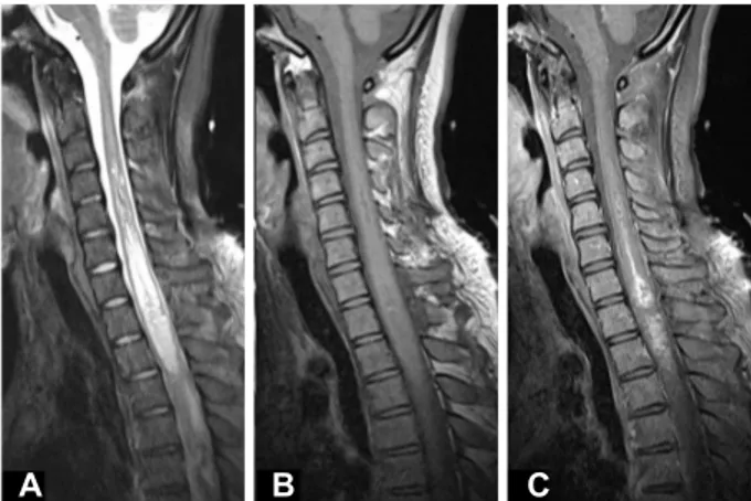 Fig. 4. Postoperative spinal MRI scan. A huge amount of the ab- ab-normal lesion decreased