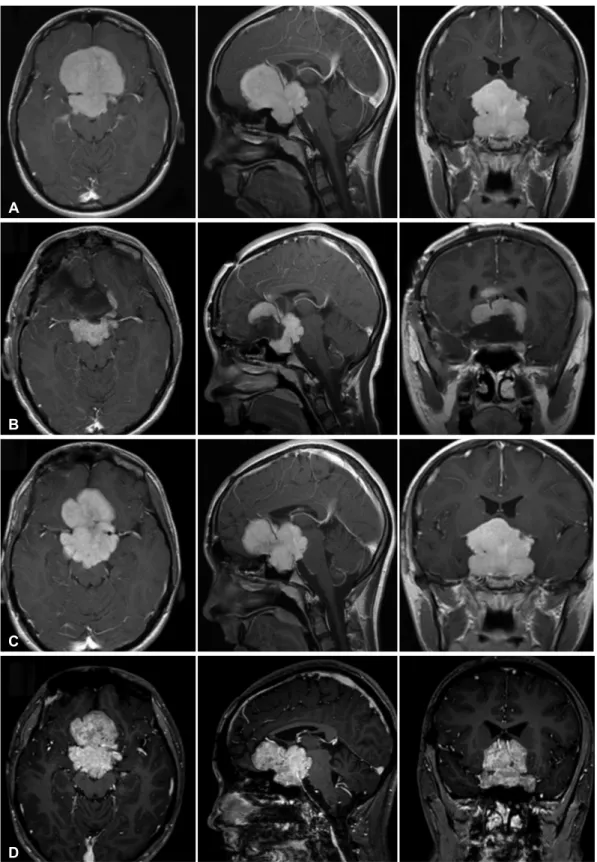 Fig. 2. T1-gadolinium-enhanced axial, sagittal, and coronal MR images showing the well-demarcated and homogeneously enhanced mass lo- lo-cated in the sella-suprasella-hypothalamic area