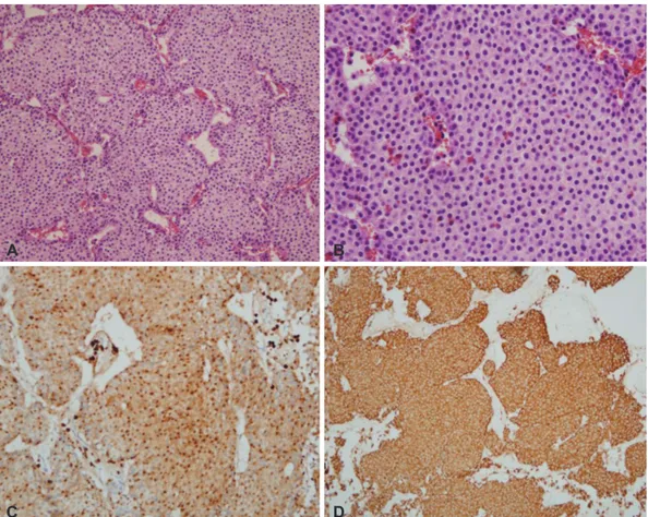 Fig. 3. Histopathology of the lesion resected during the craniotomy. A and B: Hematoxylin and eosin staining indicates a tumor of moderate  cellularity with vascular proliferation