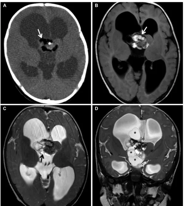 Fig. 1. A: Preoperative CT scan reveals a mass in the third ventricle with extension to the right lateral ventricle, consisting of fat components  (white arrow)