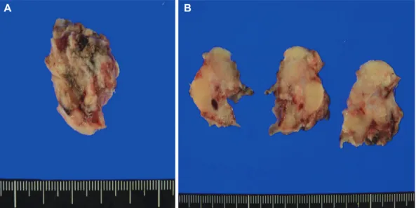 Fig. 2. A: Gross view of the tumor specimen shows a grayish white soft tissue, measuring 2.8×2.5×2 cm in dimensions