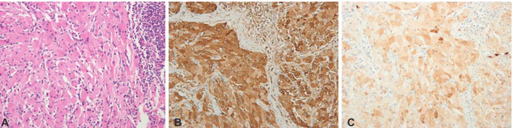 Fig. 3. Histopathologic findings. A: The tumor consists of large polygonal cells with ample granular cytoplasm and small, oval, eccentric nuclei (he- (he-matoxylin and eosin; original magnification ×100)