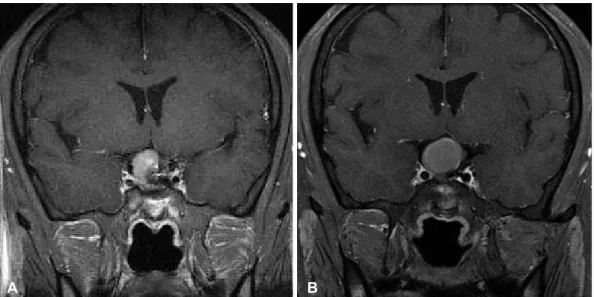 Fig. 7. Enhanced T1-weighted (A) magnetic resonance image (MRI) obtained in a 46-year-old man with a pituitary adenoma