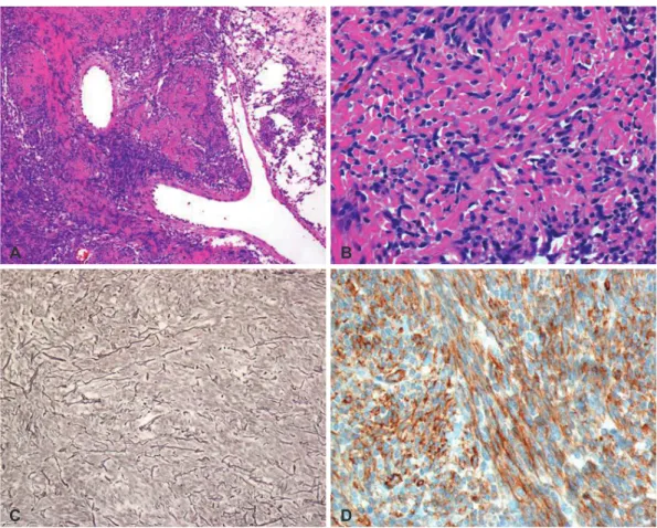 Fig. 2. Immunohistochemical features of first operation. A: On histologic examination of lower power view, mixed hypercellular and hypocellu- hypocellu-lar area are seen with multifocally laid down collagen and occasional staghorn-like vessels (H&amp;E, ×1