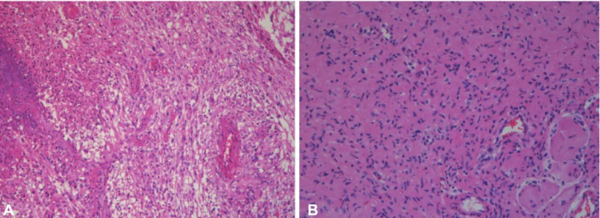 Fig. 2. Histologic examination. A: H&amp;E stain (×100) shows characteristic features of glioblastoma