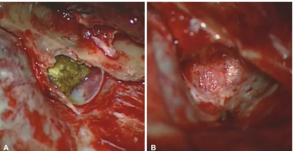 Fig. 3. Intraoperative findings: dermoid contents including capsule at epidural space of right sphenoid ridge (A)