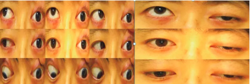 Fig. 1. A 29-year-old female presented with left-side ptosis and a fixed eyeball.