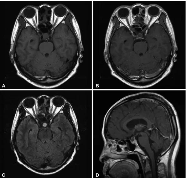 Fig.	1. Preoperative MR images. Axial T1 non-enhanced (A) and gadolinium enhanced (B) images show a well-defined intrasellar  cystic lesion, and the wall is faintly enhanced