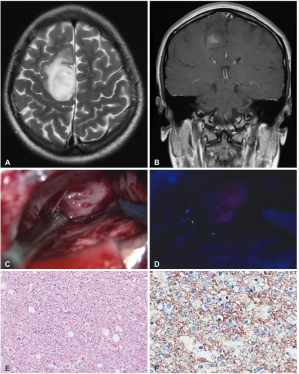 Fig.	2. A and B: A preoperative MRI scan showing a right high frontal mass with high signal intensity on a T2-weighted image and  focal enhancement on a T1-weighted image with contrast