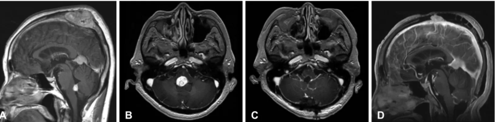 Fig. 2. Clear cell renal cell carcinoma showing solid nests of clear  cells separated by a prominent delicate vascular network