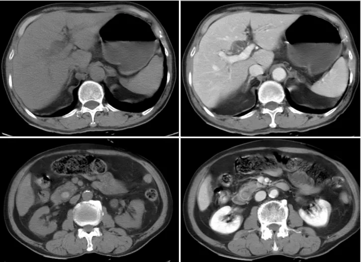 Fig.  1.  Abdominal  CT  scan.  It  demonstrates  dilated  intrahepatic  bile  duct  and  a  17×13  mm  sized  CBD  stone  in  the  distal  CBD