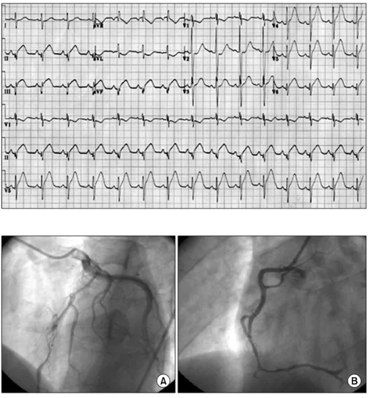 Fig.  1.  The  ECG  showed  Q  wave  with  ST-segment  elevation  in  II,  III,  and  aVF.