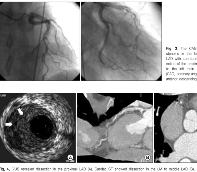 Fig.  4.  IVUS  revealed  dissection  in  the  proximal  LAD  (A).  Cardiac  CT  showed  dissection  in  the  LM  to  middle  LAD  (B),  and  dissection  in the  proximal  RCA  (C)  (IVUS,  intravascular  ultrasonography;  LM,  left  main  coronary  artery