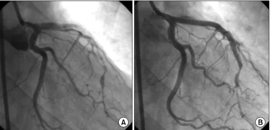 Fig.  5.  CAG  revealed  dissection  in  the  LM  to  middle  LAD  and  proximal LCx  with  poor  distal  flow  and  spasm in  the  distal  LAD  (A)